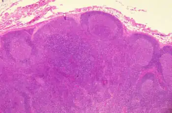 microfotografia tessuto linfonodale infettato HIV