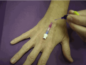 Figure 1 Securement with transparent cloth bordered polyurethane dressing and tape