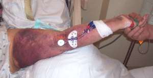 PICC ematoma braccio