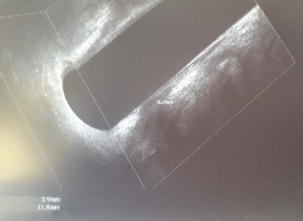 eco tranrettale 3d sezione