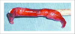 fibrin sheath