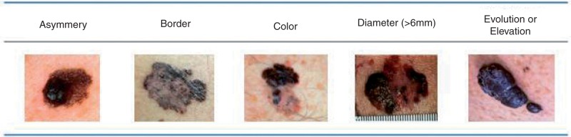 melanoma abcde