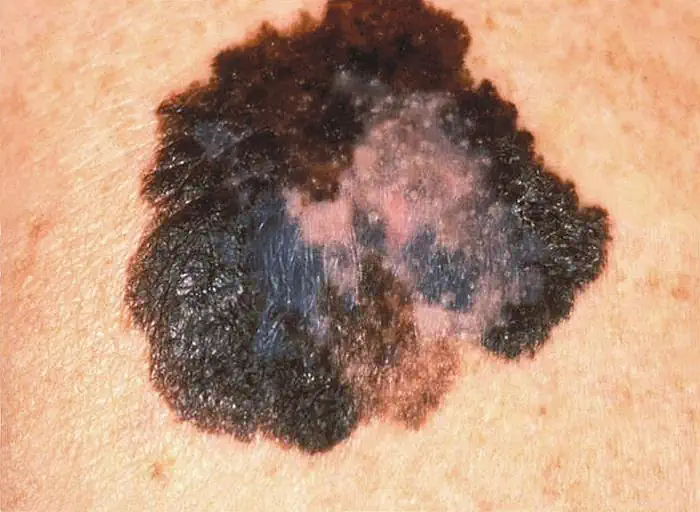 Melanoma eterogeneo screziato multicolore