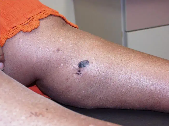 Melanoma polpaccio