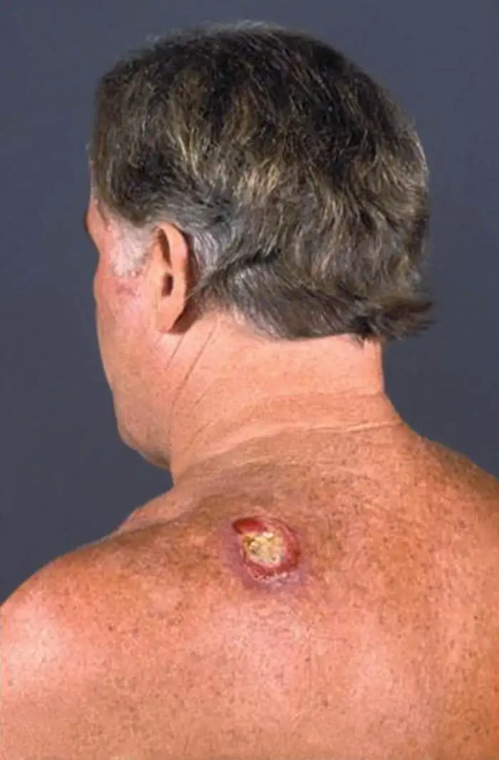 Melanoma schiena