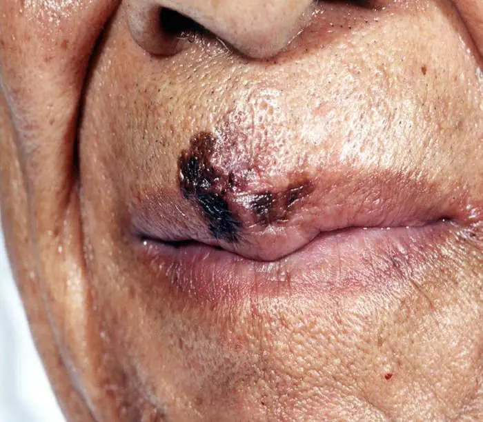 Melanoma labbro superiore