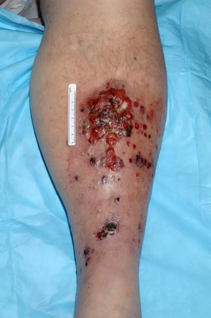 Melanoma metastatico gamba