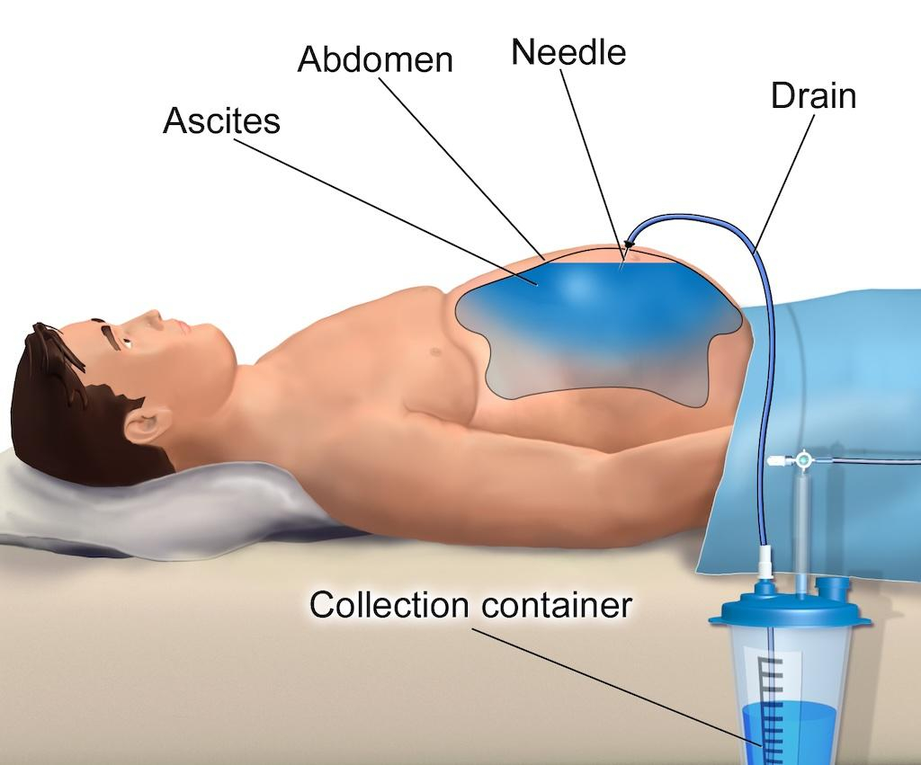 paracentesi wikipedia