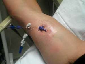 picc line senza medicazione