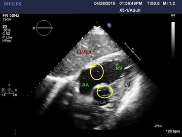 rsz bolle aria cavita cuore