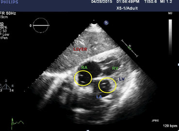 rsz bolle aria cavita cuore2