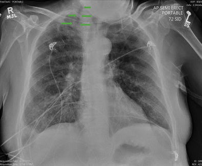 rsz bolle aria cavita cuore3