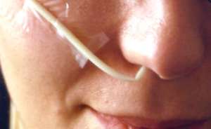 sondino naso gastrico piegato