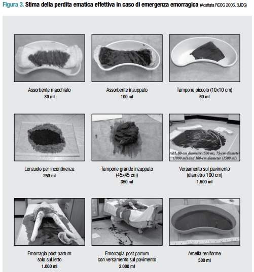 stima perdita ematica post partum