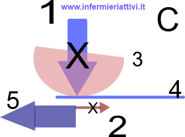 lesione da trazione forse in azione nella lesione
